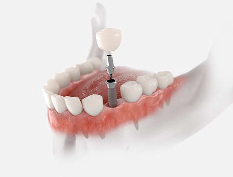 Imagem de Implantes Dentários na Clínica Espaço Odonto