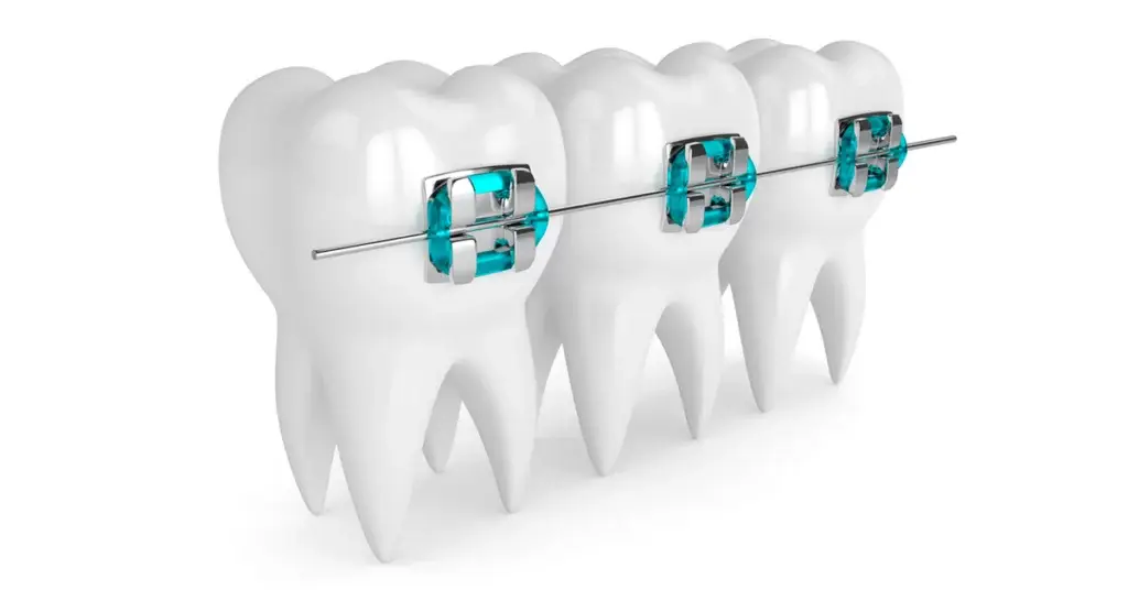 Sinais que Indicam a Necessidade de Usar Aparelho Ortodôntico Como Identificar e Agir a Tempo.