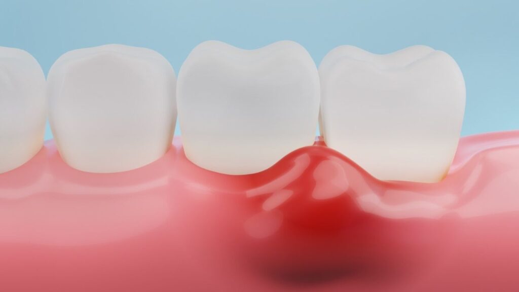 Placa Bacteriana: O Que É, Quais os Riscos e Como Evitar 