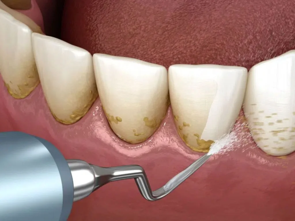 Prevenção do tártaro