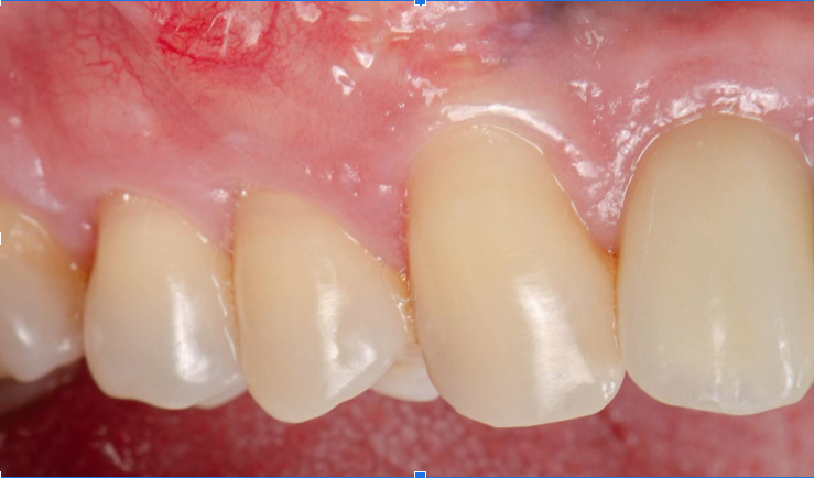 O que é recobrimento radicular